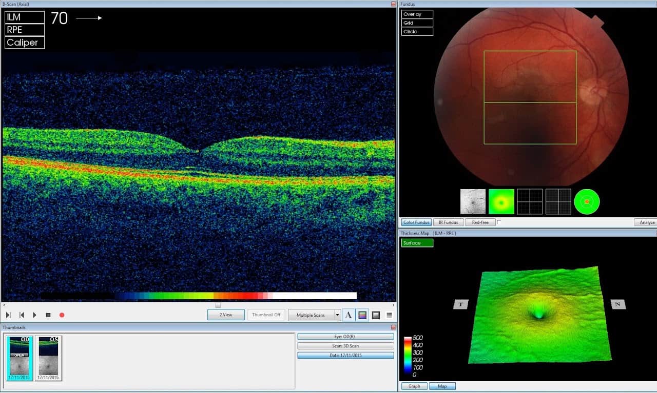 Image shows a coloured OCT image and afundus scan