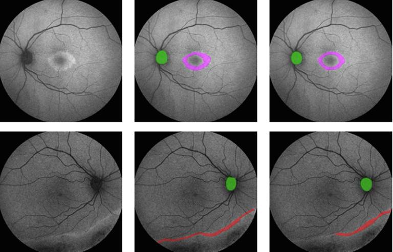AI accelerates retinal disease analysis in largest study to date - NIHR ...