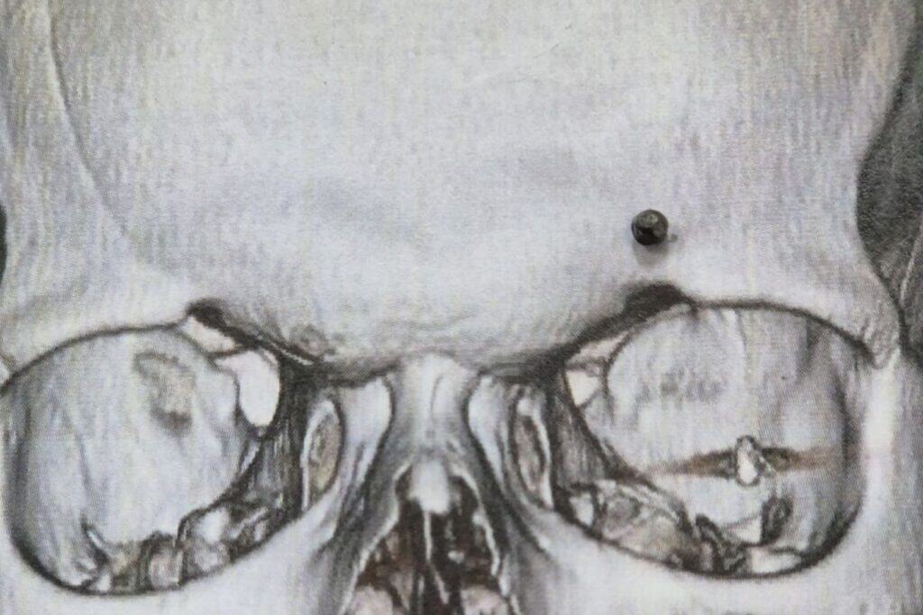 Scan image of a human skull belonging to patient Minhaj focusing on the eye area showing a bullet lodged above the left eye.