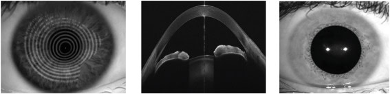 Three side-by-side images showing different ways of examining an eye. The first image shows a close-up of the eye’s surface with circular rings reflected on it, mapping its shape. The middle image shows a cross-section view of the front of the eye taken with a scanning technique. The third image is a standard photograph of an eye looking straight ahead, showing the iris and pupil.
